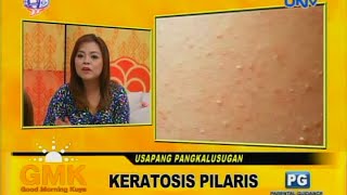 Keratosis Pilaris chicken skin [upl. by Worl444]