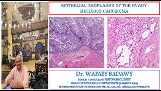 EPITHELIAL NEOPLASMS OF THE OVARY MUCINOUS CARCINOMA BY DR WAFAEY BADAWY [upl. by Yrian633]