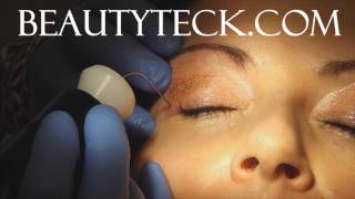 Upper eyelid tightening using plasma medium intensity treatments examples The BeautyTeck [upl. by Kerekes671]