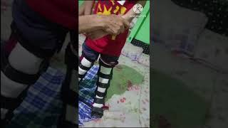 Cerebral palsy AFOOrthosis support [upl. by Ailekat258]