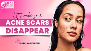 Magically Disappear Acne Scars Comprehensive Treatment Guide [upl. by Anderson]