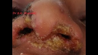 Severe Case of Vestibulitis amp Perichondritis [upl. by Xirdnek]