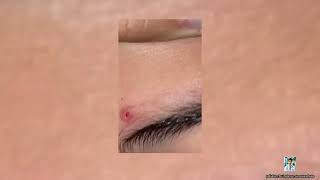 Ultimate Pimple Popping 2024 Fascinating Pimple Removals [upl. by Ahsinnek]