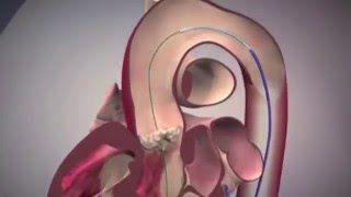 TAVR Technique for Heart Valve Replacement [upl. by Bradan]