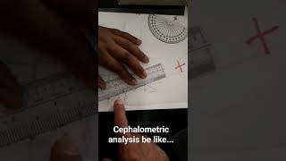 Cephalometric analysis detectivework orthodontics smile subscribe credits comment antropology [upl. by Supen]