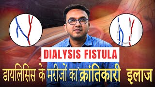 Dialysis Fistula क्या है ये और इसका क्रांतिकारी इलाज  Revolutionary Treatment Explained [upl. by Miahc707]