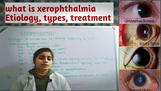 what is XEROPHTHALMIA आँखों का सूखा रोग  Etiology types treatment   Optometry solution [upl. by Ardnaxila]