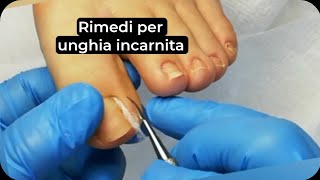 Rimedi per unghia incarnita Come applicare il cotone sotto lunghia incarnita [upl. by Philippa]