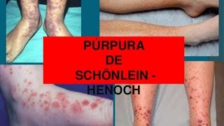 Purpura de Henoch schonlein  conferencia pediatria [upl. by Shena488]