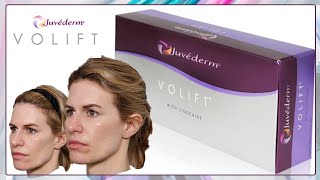 Lip and Cheek Filler Juvederm Volift with Before and After Pictures [upl. by Iad]