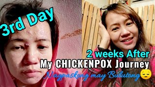 Chickenpox Journey  In just 2 weeks everything is going back to normal  Nagpaskong may Bulutong😔 [upl. by Atnima]