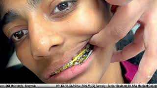 Forsus Appliance in Orthodontics  Dr Kapil Saroha BDS MDS [upl. by Pry]