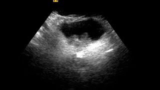 Urinary Bladder Mass  Differential Diagnosis [upl. by Verena763]