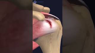 REVERSE shoulder replacement SURGERY  Dr Sharath Babu Nilagiri  shouldersurgery shoulderpain [upl. by Yeung]