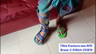 Tibial Fracture Brace ankle foot orthosis AFOব্যবহারের উপকার পাবেন। ✆ 01644511819 [upl. by Gui789]