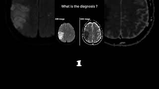 Diffusion weighted imaging – Infarct brain Quiz 19 radiologychannel007 [upl. by Kowal]