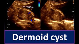 Understanding Dermoid Cyst  Guide to Ultrasonogram Diagnosis Ovarian Cyst  Practical Ultrasonogram [upl. by Kast]