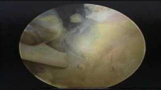 Arthroscopic Suprascapular Nerve Release [upl. by Rafa281]