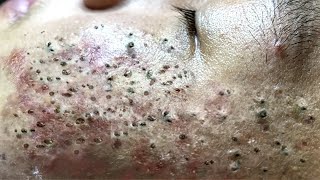 Blackhead Removal With Sac Dep Spa 100074091 [upl. by Eveineg239]