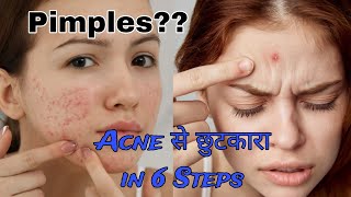 How To Remove Pimples  How To Get Rid Of Pimples  Acne video viralvideo youtubevideo acne diy [upl. by Yelnet75]