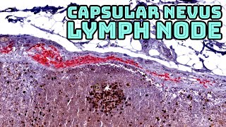 Benign Nevus in a Sentinel Lymph Node Capsular nevus with Ki67MART1 immunostain pathology [upl. by Assenav649]