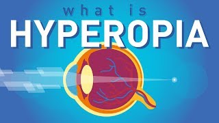 What is Hyperopia Farsightedness [upl. by Nnyledam]