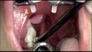 Tonsil Cryptolysis to Address Tonsil Stones [upl. by Stauder772]