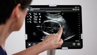 Fetal Head Measurements [upl. by Linnell]