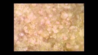 Scabies mites on skin crust [upl. by Attennaej872]