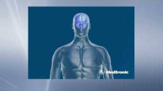 Deep Brain Stimulation  How does DBS work [upl. by Eecyac]