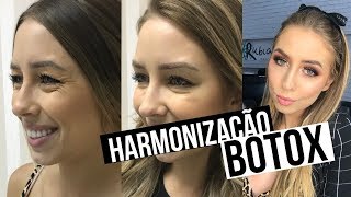 PREENCHIMENTO DE OLHEIRAS  ANTES x DEPOIS harmonização facial e botox [upl. by Snilloc]