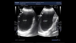 Ultrasound Video showing a large Hepatic hydatid Cyst [upl. by Dachia207]