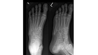 5th Metatarsal avulsion fracture [upl. by Kcirtemed544]