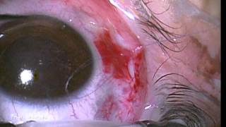 Conjunctival laceration repair technique [upl. by Sitra]