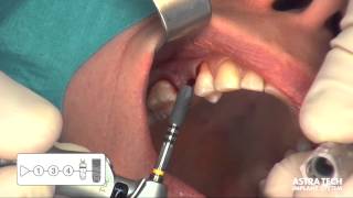 Astra Tech Implant System EV  Maxillary premolar single tooth case [upl. by Enyalaj769]