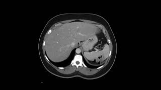 Retroperitoneal Leiomyosarcoma [upl. by Corissa]