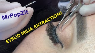 Eyelid MILIA removal Soft touch required Patient so happy it was there a long time [upl. by Ardine387]