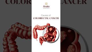 Understanding Colon Cancer Risk Factors and Causes  Dr Sharvani Duba Arete Hospitals coloncancer [upl. by Atirak]