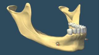 Efeito da perda dentária Perda óssea posterior de mandíbula [upl. by Oralia]