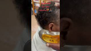 Impacted ear wax removal satisfyingvideo waxremoval earwaxremoval blockedears Audiologist [upl. by Ahsead407]