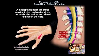 Compression of the Spinal Cord amp Hand Function  Everything You Need To Know  Dr Nabil Ebraheim [upl. by Iover]