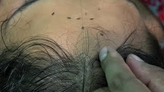 Head Lice amp Nits Picking and Popping with Nails [upl. by Berte]