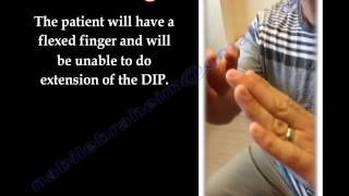 Mallet Finger  Everything You Need To Know  Dr Nabil Ebraheim [upl. by Neeuq]