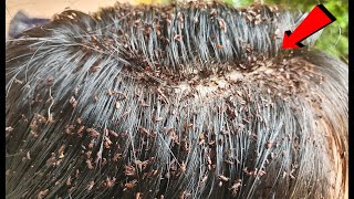 Long Hair Lice Treatment Removal  Head Lice Treatment Step by Step [upl. by Ellis]