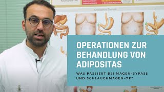 Operationen zur Behandlung von Adipositas Was passiert bei MagenBypass und SchlauchmagenOP [upl. by Reywas]