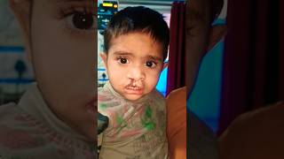 viralvideo Smile train Anand Hospital Meerut UP Cleft Lip amp Palate free surgery Ravindrasaini [upl. by Ymac]