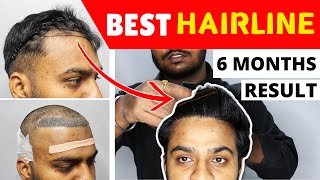 6 Months Full Hair Transplant Journey In 10 Minutes  Best FUE Hair Transplant Result In India [upl. by Bab]