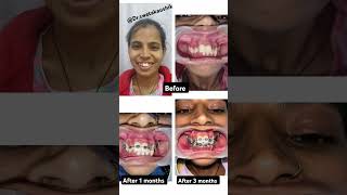 Orthodontic treatment journey before and after trendingshorts Drswetakaushik [upl. by Ahseral735]