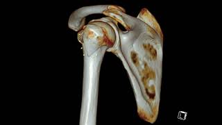 Humerus Greater Tuberosity Fracture [upl. by Amata]