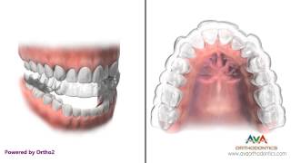 How Invisalign or Clear Aligners work  Orthodontic Treatment [upl. by Cassi]